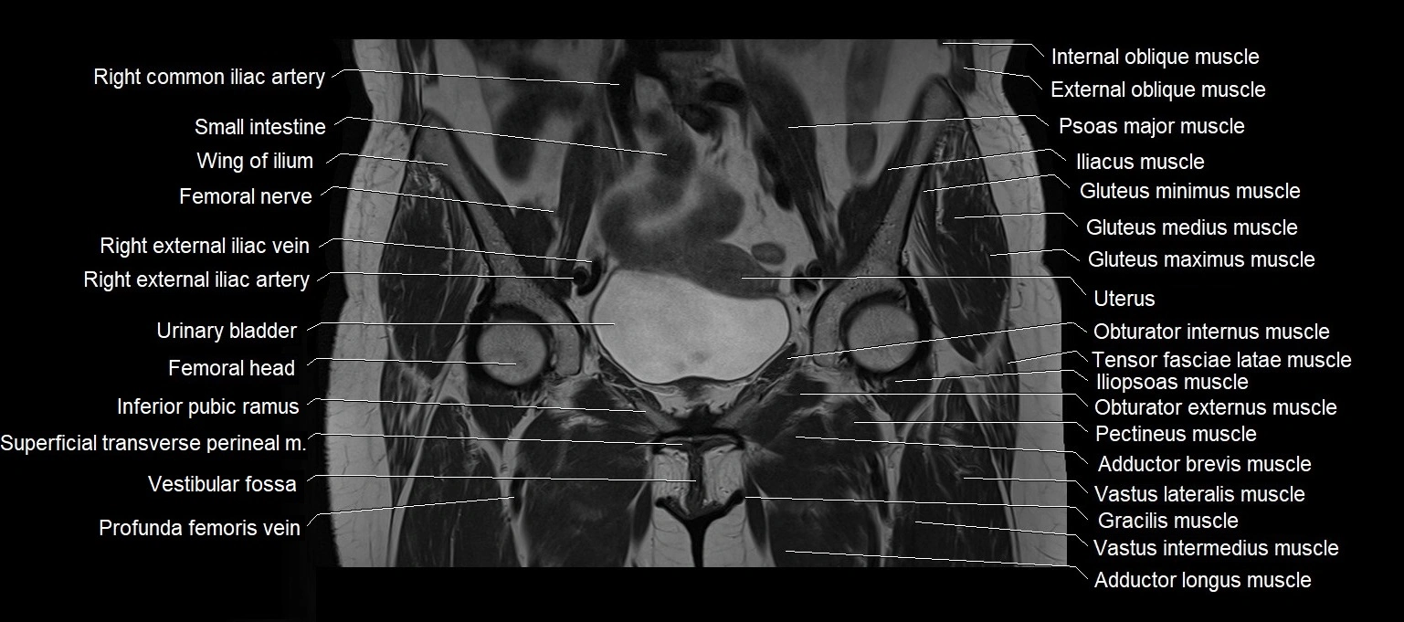 MRI 3T pelvis coronal cross section anatomy image 10.webp